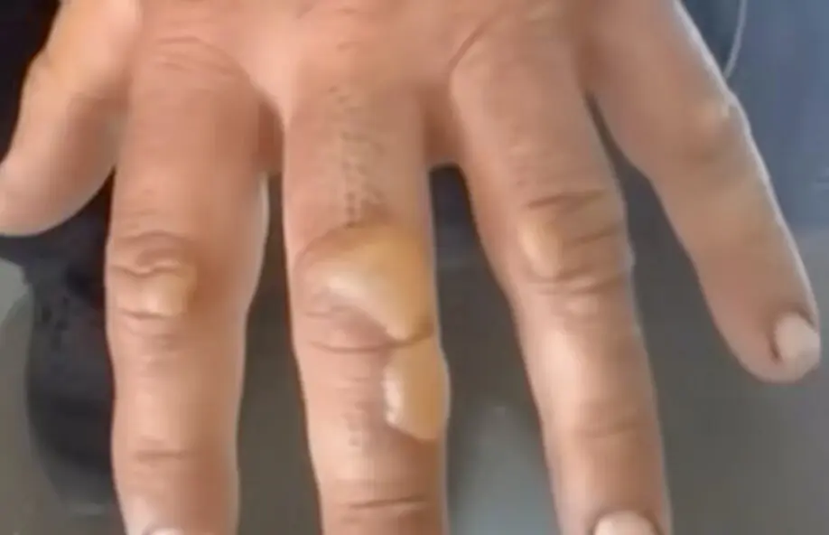 La mano llena de ampollas