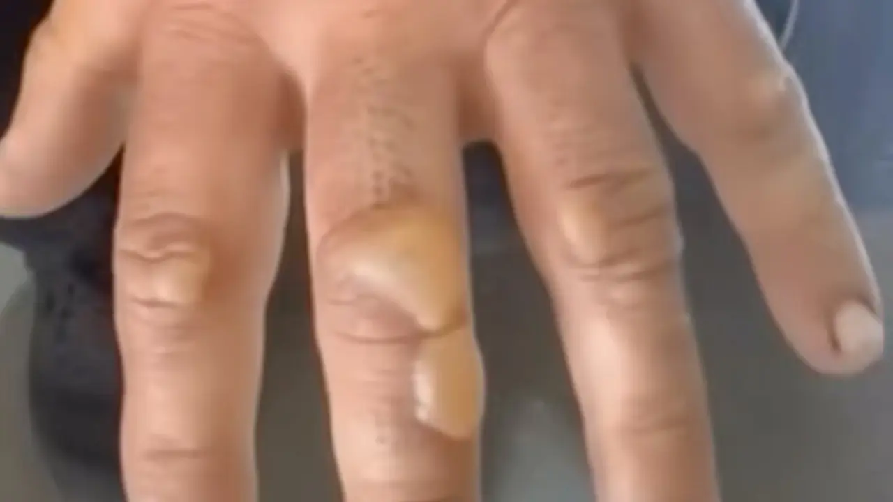 La mano llena de ampollas